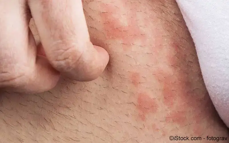 Kontaktallergie | Rehakliniken